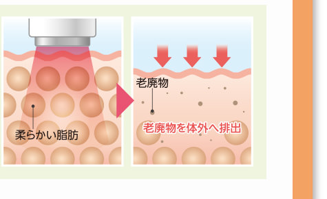 キャビテーション