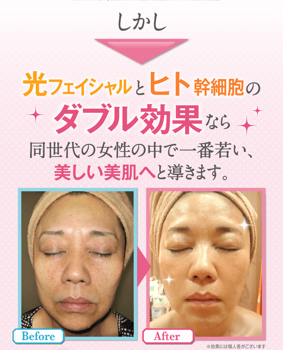 しかし、光フェイシャルとヒト幹細胞のダブル効果なら同世代の女性の中で一番若い、美しい美肌へと導きます。